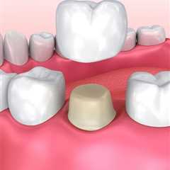 Dental Crowns | Perth, Rivervale, Belmont, And Burswood