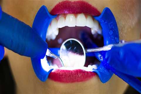 Exploring Different Types Of Dental Veneers In Taylor, TX