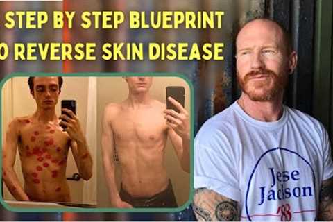 Revealing the complete step by step BLUEPRINT for permanent eczema, psoriasis, dermatitis reversal