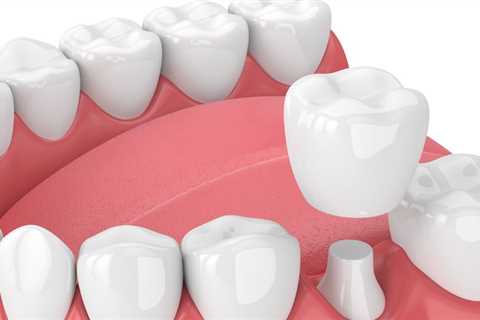 Temporary Crown is Sensitive Solutions - Best Dental Reviews