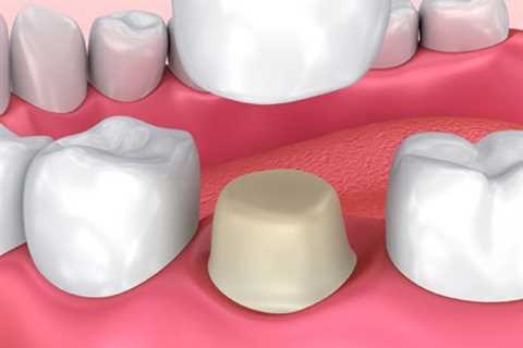 Dental Crowns | Perth, Rivervale, Belmont, And Burswood