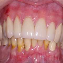Do veneers permanently damage teeth?