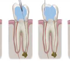 Dental Veneers And Emergency Root Canal Treatment In London: What To Expect