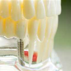 The Process For Getting Dental Implants In McGregor