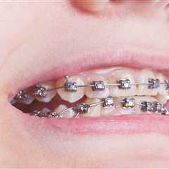 How Do Braces Move Teeth: Understanding Orthodontic Mechanics