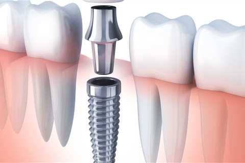 Why Now Is The Perfect Time To Consider Dental Implants In Mission Viejo