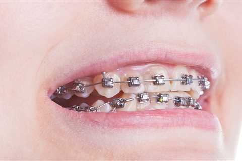 How Do Braces Move Teeth: Understanding Orthodontic Mechanics