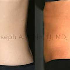 Lipo 360 for Circumferential Trunk Liposculpture