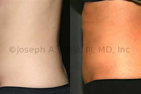 Lipo 360 for Circumferential Trunk Liposculpture