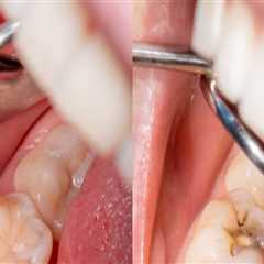 Care for Fillings: Everything You Need to Know