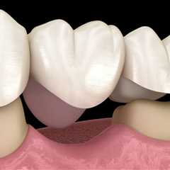 The Process for Getting a Dental Bridge: Everything You Need to Know