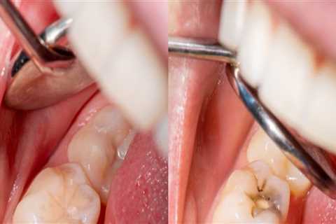 Care for Fillings: Everything You Need to Know