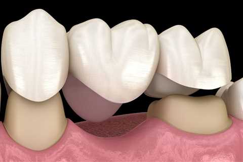 The Process for Getting a Dental Bridge: Everything You Need to Know