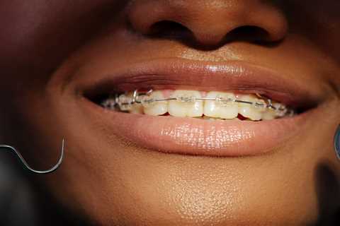 Can You Put Color on Clear Braces?