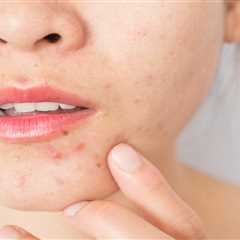 Understanding Perioral Dermatitis: A Comprehensive Guide