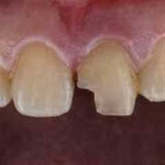 Chipped, cracked, and broken teeth: Causes, symptoms, and treatments