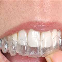 Straighten Your Teeth Invisibly: Invisalign Clear Braces In North Kansas City