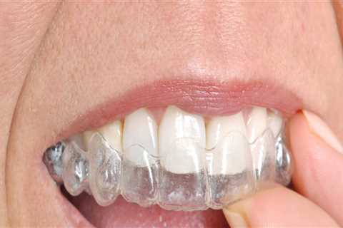 Straighten Your Teeth Invisibly: Invisalign Clear Braces In North Kansas City