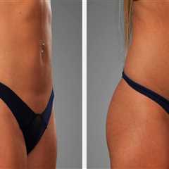How Can A Fat Transfer Specialist Boost Confidence And Support Personal Development For Mental..