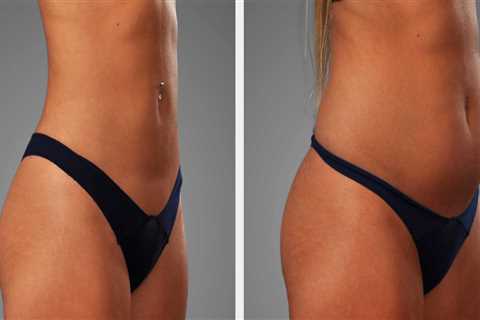 How Can A Fat Transfer Specialist Boost Confidence And Support Personal Development For Mental..