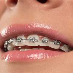 The Best Oral Hygiene Routine for Metal Braces Wearers