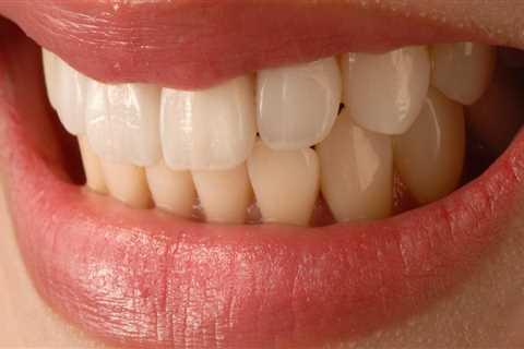 Transform Your Smile with Veneers and Orthopedics in Mill Creek