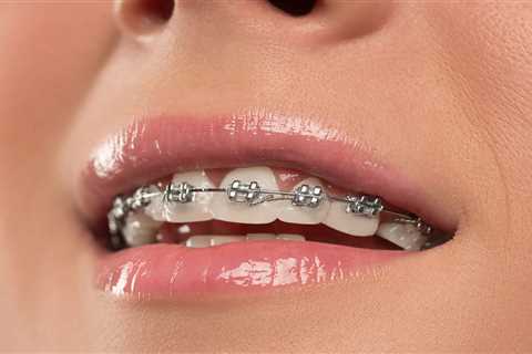 The Best Oral Hygiene Routine for Metal Braces Wearers