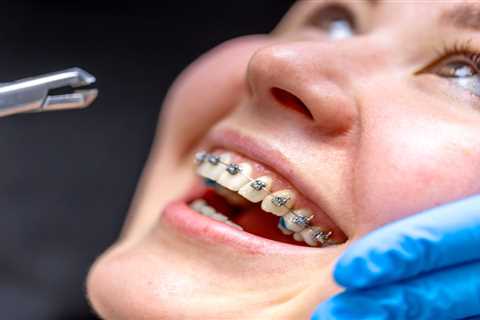 Why Traditional Braces Are Still a Favoured Choice in Sanger
