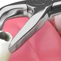 Tooth Extraction and the Importance of Careful Evaluation