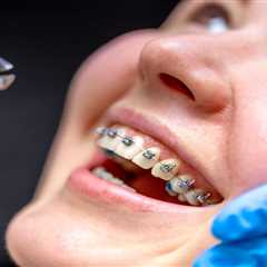 The Process of Getting Traditional Metal Braces in Tempe: What to Expect