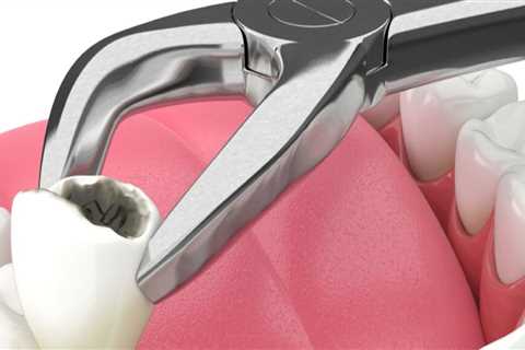 Tooth Extraction and the Importance of Careful Evaluation