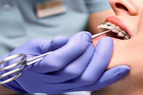 What Adults Should Know About Getting Traditional Metal Braces