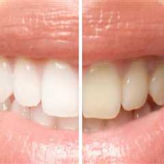 Understanding the Distinction Between Teeth Cleaning and Teeth Whitening