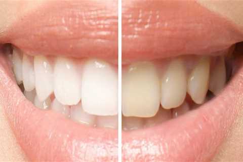 Understanding the Distinction Between Teeth Cleaning and Teeth Whitening