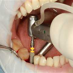 Dental Implants in Switzerland: Modern Solutions for Lasting Smiles