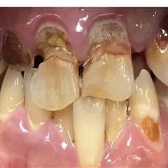 Cosmetic Dentistry in Switzerland After Tooth Extraction: Restoring Natural Smiles