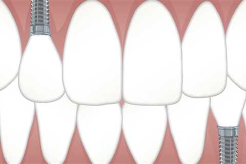 Transform Your Smile with Dental Implants in North Little Rock