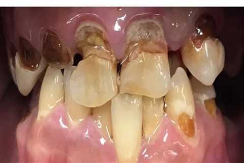 Cosmetic Dentistry in Switzerland After Tooth Extraction: Restoring Natural Smiles