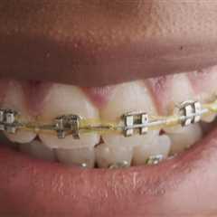 Understanding Payment Plans for Affordable Braces