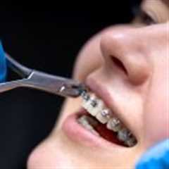 How Long Do Braces Take? A Complete Guide to Orthodontic Treatment Timelines
