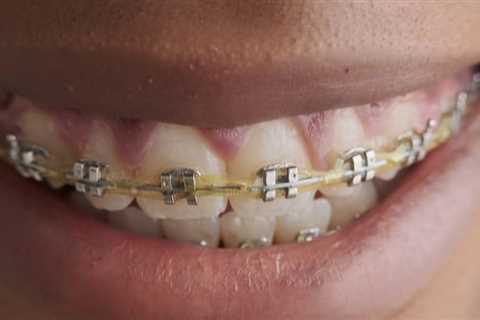 Understanding Payment Plans for Affordable Braces