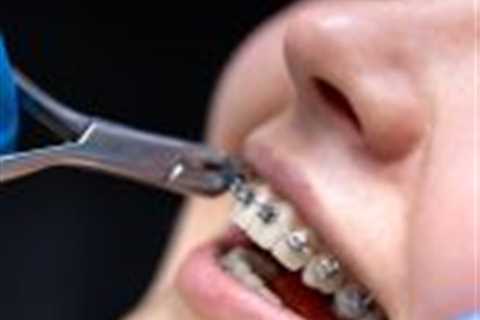 How Long Do Braces Take? A Complete Guide to Orthodontic Treatment Timelines