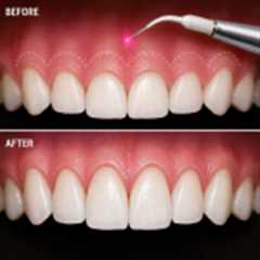 Laser Gum Contouring & Crown Lengthening
