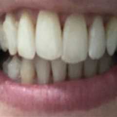 Why Some Invisalign Cases Require More Refinement Stages Than Expected