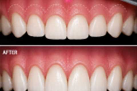 Laser Gum Contouring & Crown Lengthening
